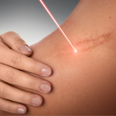 Scar removal